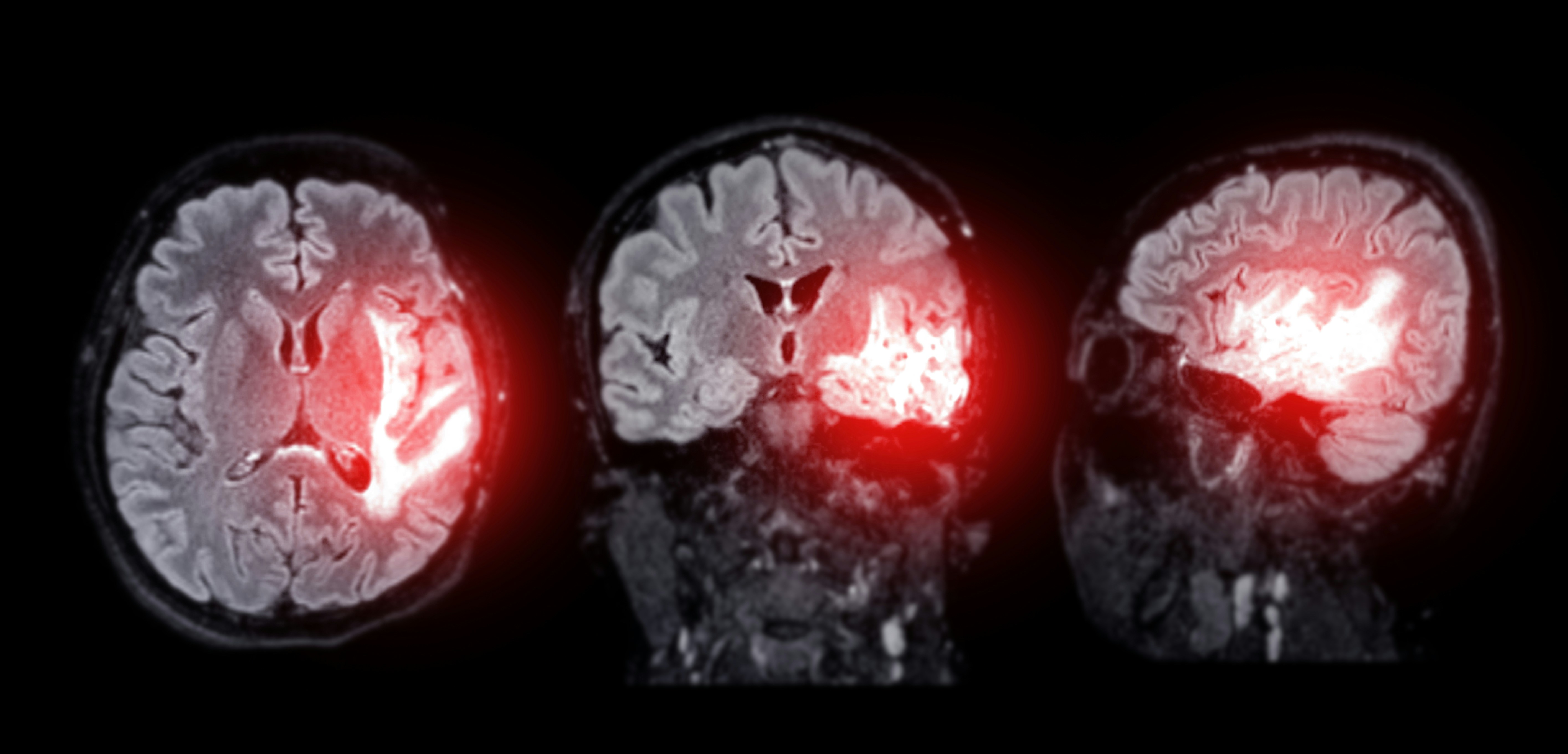 Thermal Imaging for Precision Brain Tumour Surgery